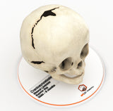 Infant Skull With Bilateral Craniosynostosis of the Lambdoid Suture - Male, 8 Months