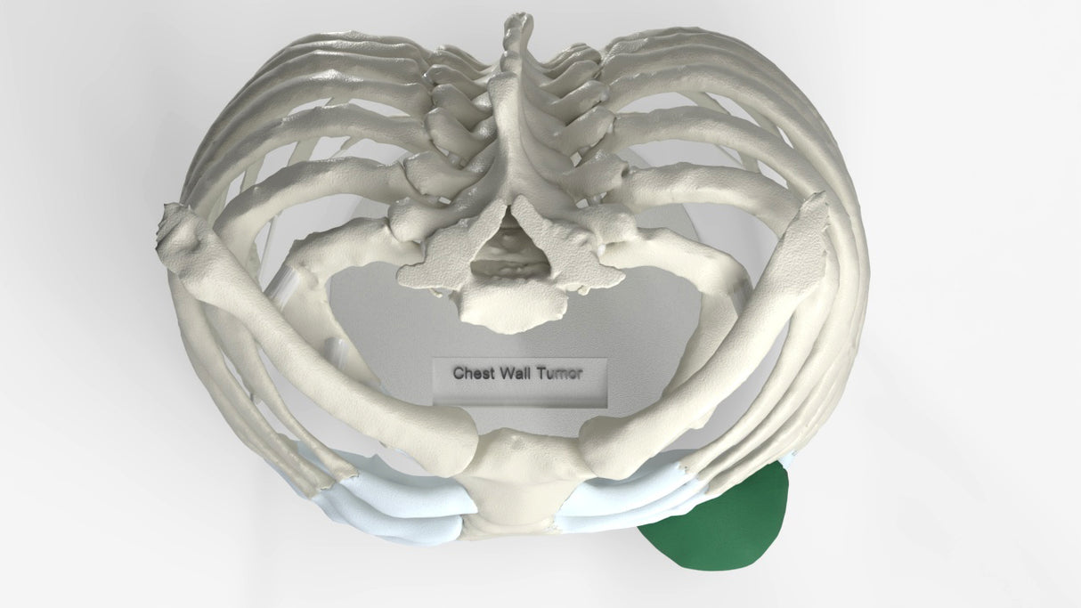 Chest Wall with Tumor