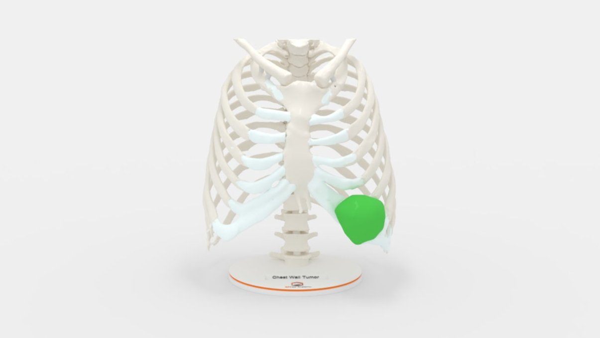 Chest Wall Tumor