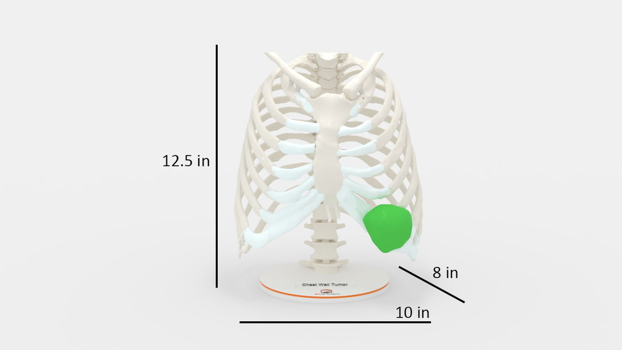 Chest Wall Tumor
