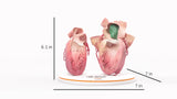 Left Atrium Myxoma, Open - Female, 73 Years