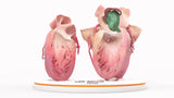 Left Atrium Myxoma, Open - Female, 73 Years