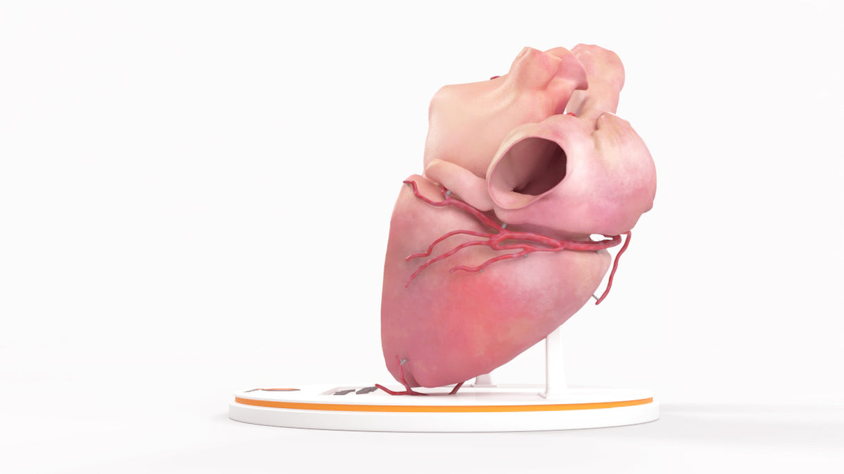 Left Atrium Myxoma, Open - Female, 73 Years