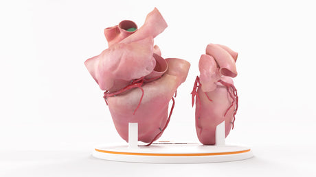 Left Atrium Myxoma, Open - Female, 73 Years