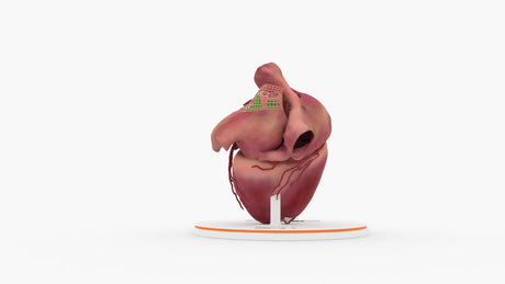 Left Atrium Myxoma, Closed - Female, 73 Years