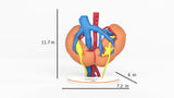 Horseshoe Kidney With Renal Cell Carcinoma (RCC) – Male, 41 Years