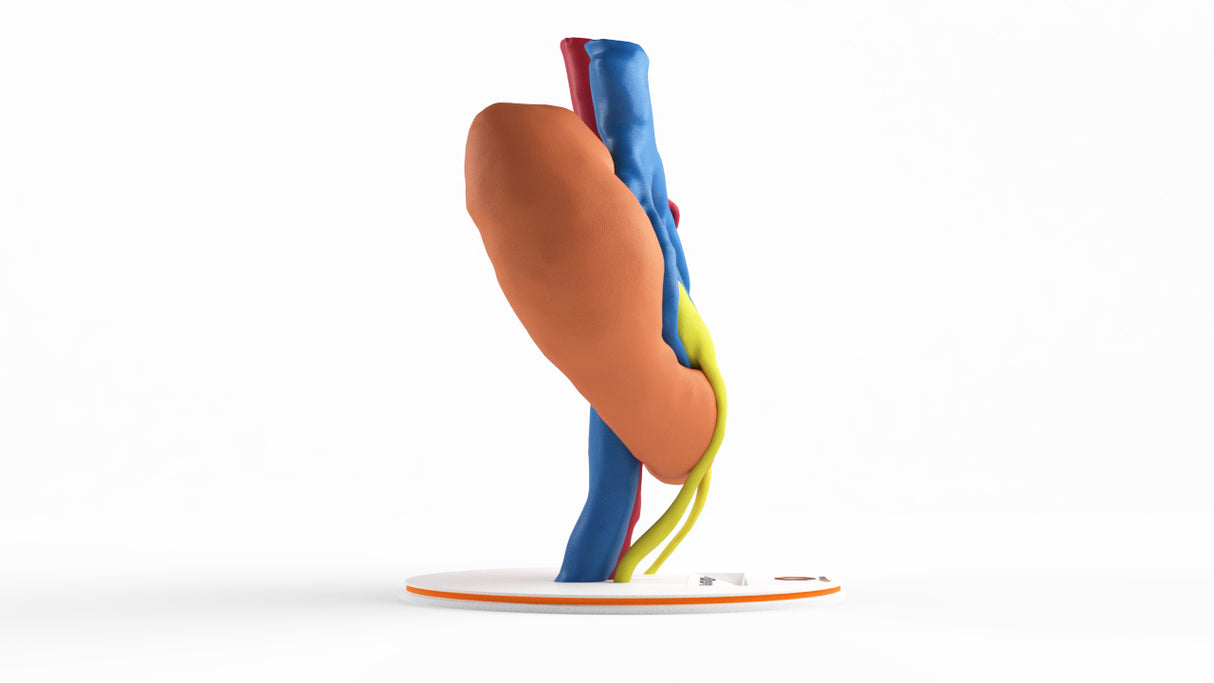 Horseshoe Kidney With Renal Cell Carcinoma (RCC) – Male, 41 Years