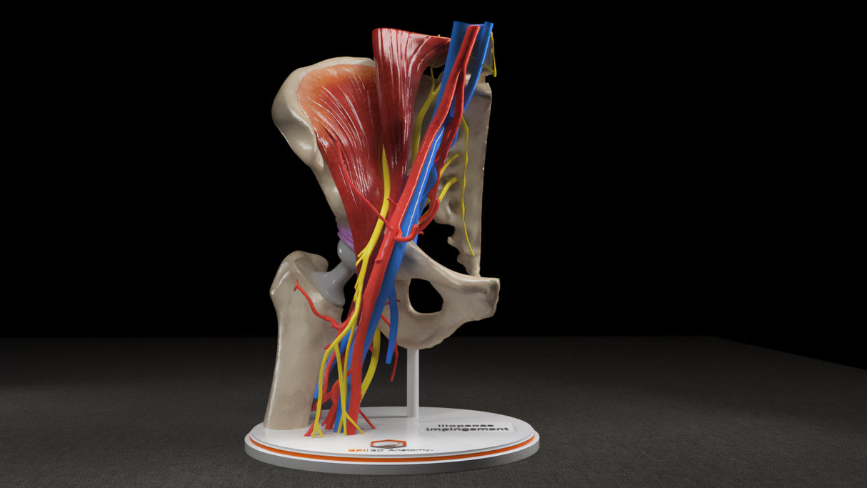 Hip Joint With Iliopsoas Fractional Lengthening (IFL) After Total Hip Arthroplasty