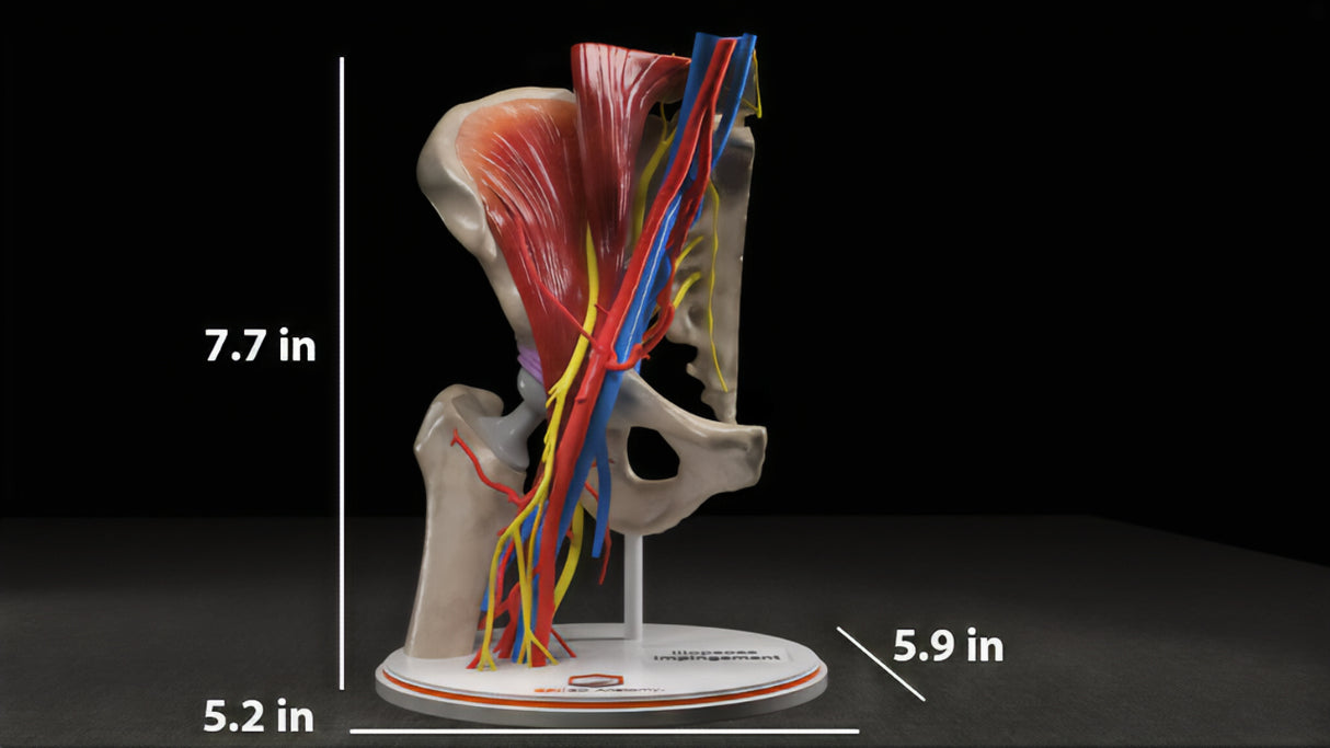 Hip Joint With Iliopsoas Fractional Lengthening (IFL) After Total Hip Arthroplasty