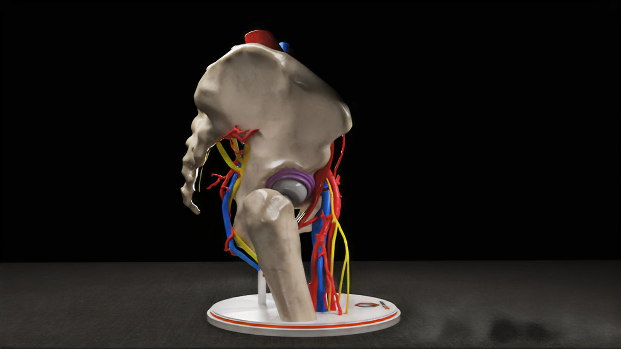 Hip Joint With Iliopsoas Fractional Lengthening (IFL) After Total Hip Arthroplasty