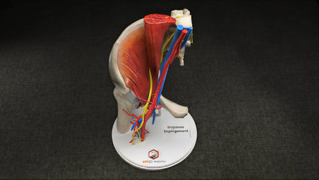 Hip Joint With Iliopsoas Fractional Lengthening (IFL) After Total Hip Arthroplasty