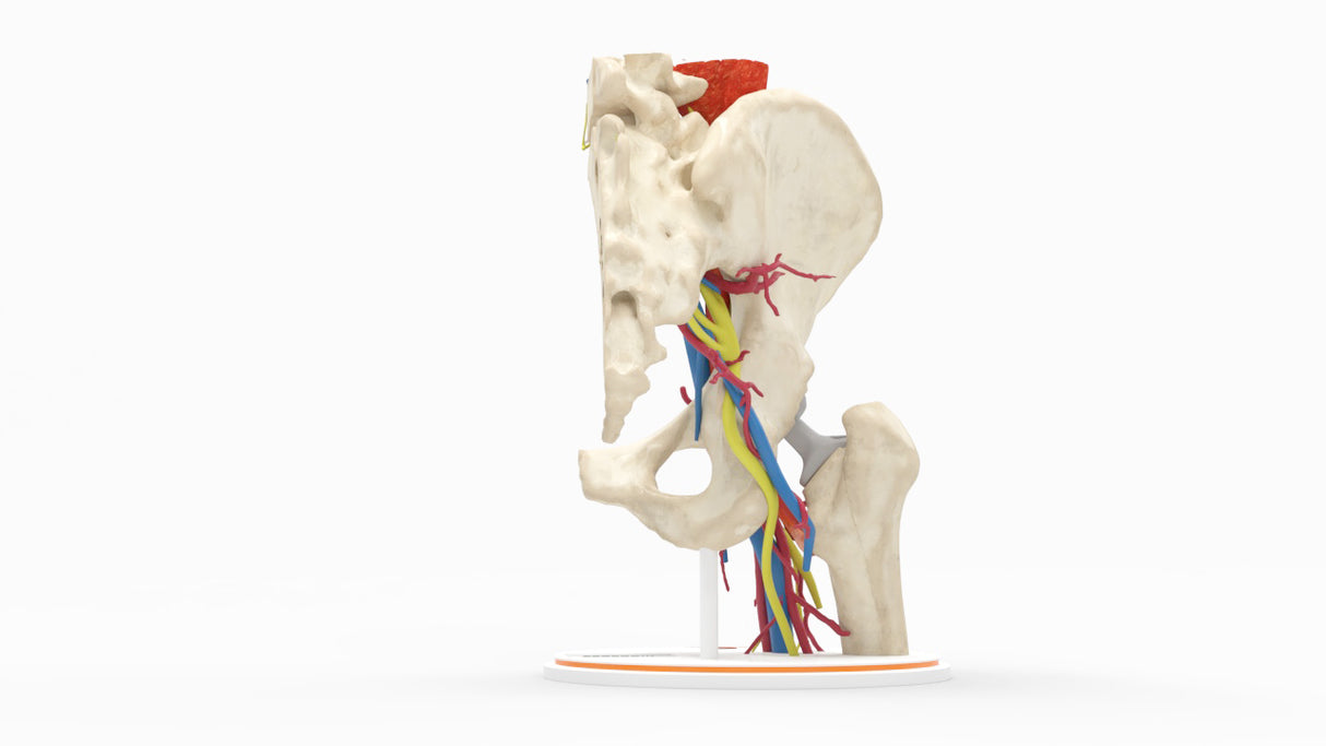 Iliopsoas Impingement