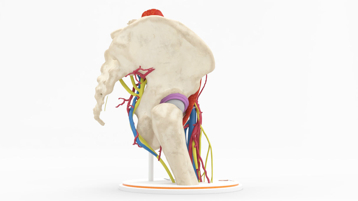 Iliopsoas Impingement