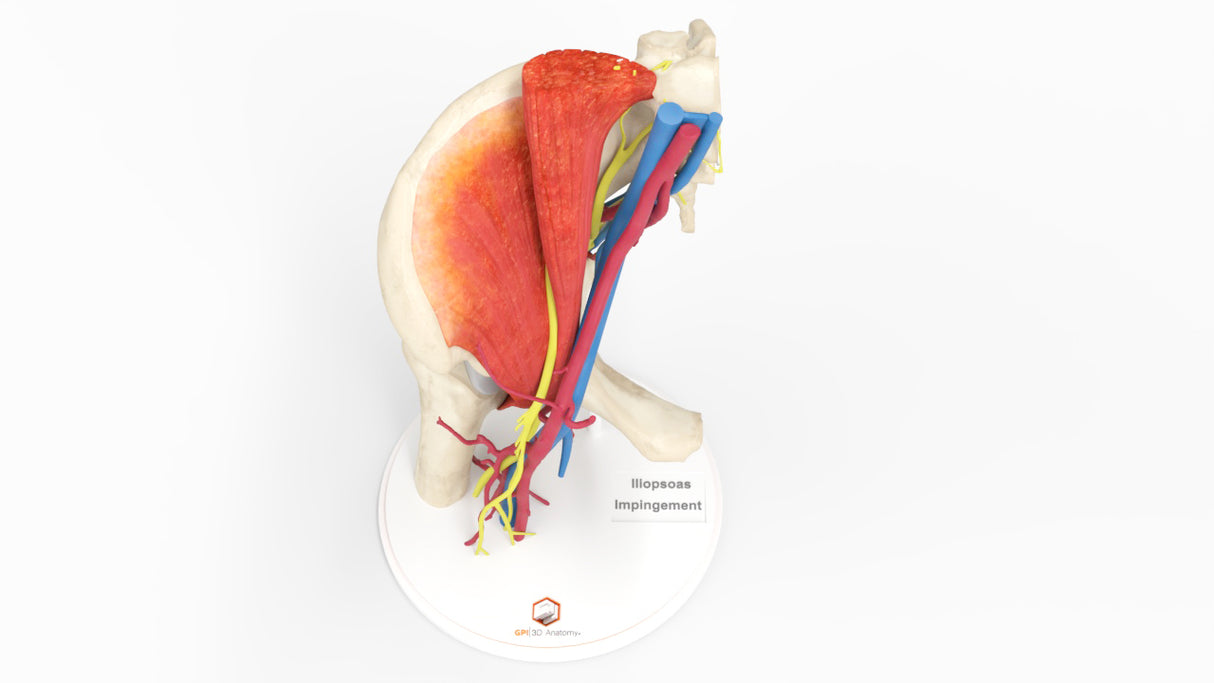 Iliopsoas Impingement