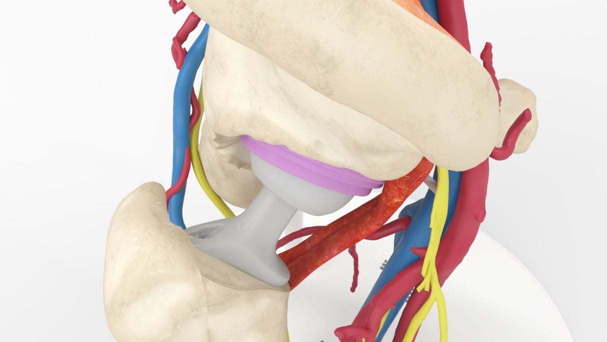 Iliopsoas Impingement