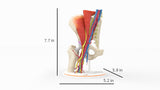 Iliopsoas Impingement