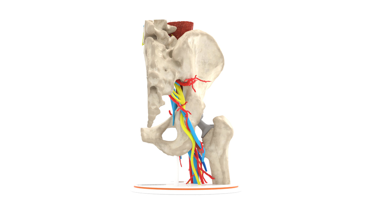 Iliopsoas Impingement