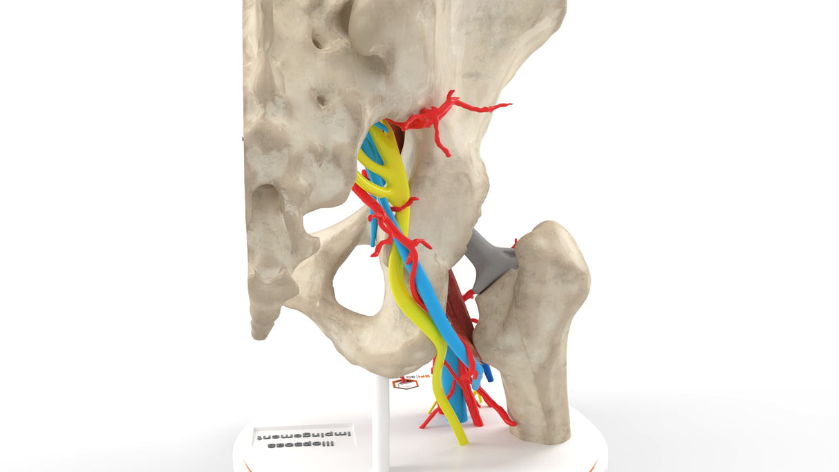 Iliopsoas Impingement