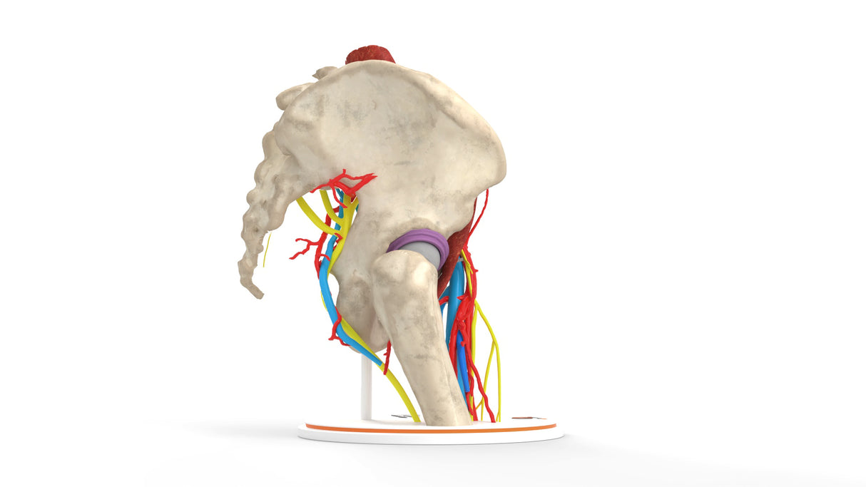 Iliopsoas Impingement