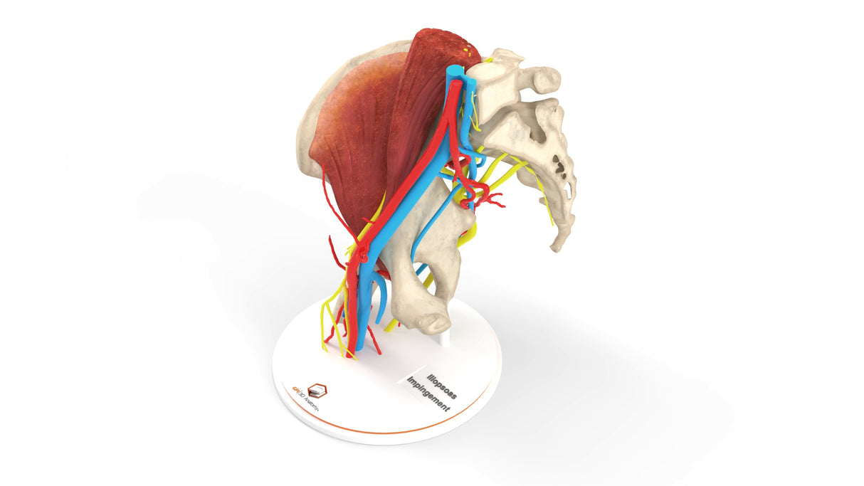 Iliopsoas Impingement