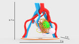 Lattice Left Kidney With Neoplasm and Cysts – Male, 78 Years