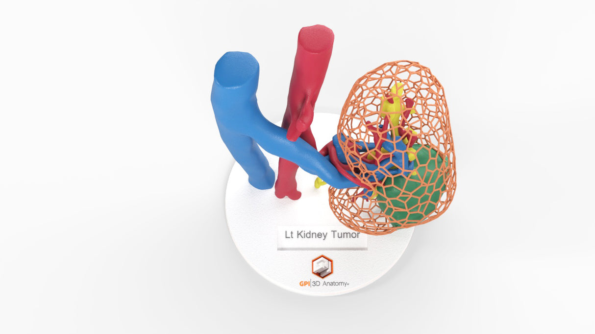 Lattice Left Kidney With Neoplasm - Male, 50