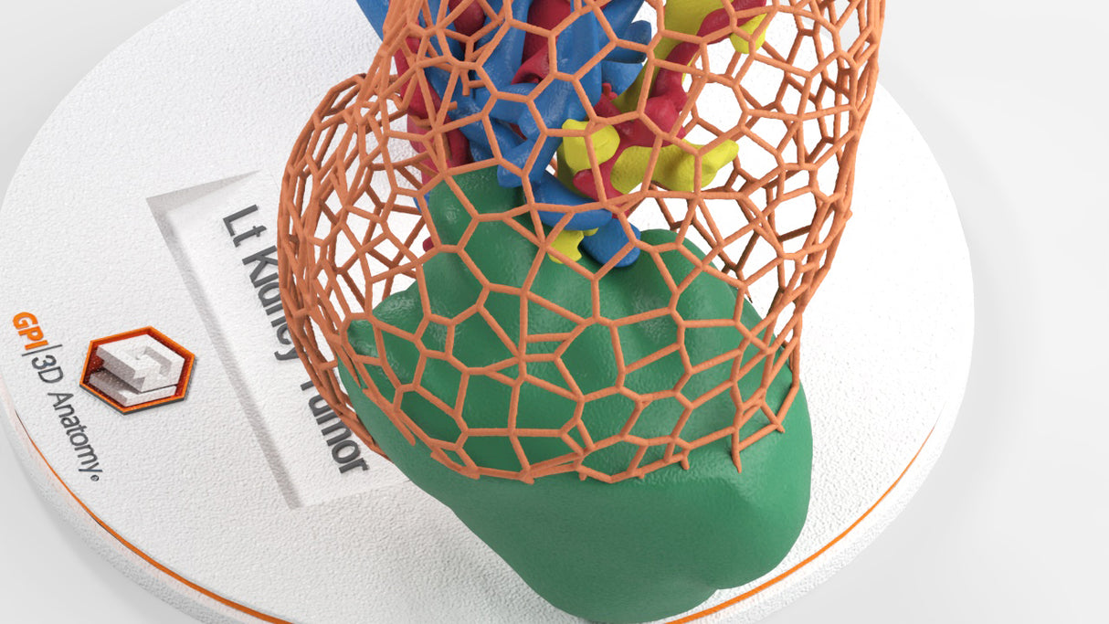 Lattice Left Kidney With Neoplasm - Male, 50