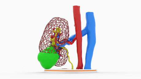 Lattice Left Kidney With Neoplasm - Male, 50