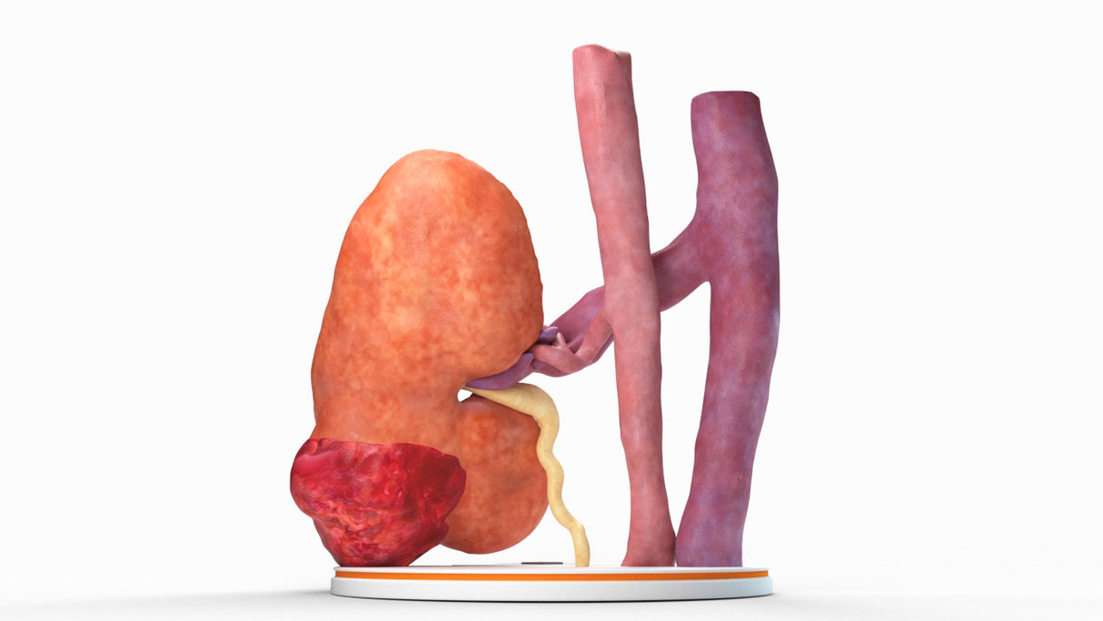 Realistic Left Kidney With Neoplasm - Male, 50 Years