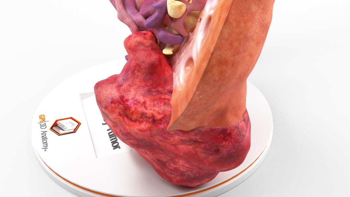 Realistic Left Kidney With Neoplasm - Male, 50 Years