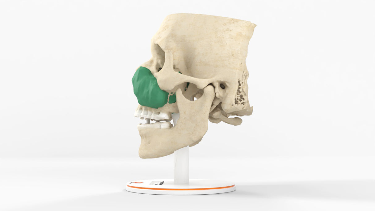 Maxillary Sinus Tumor