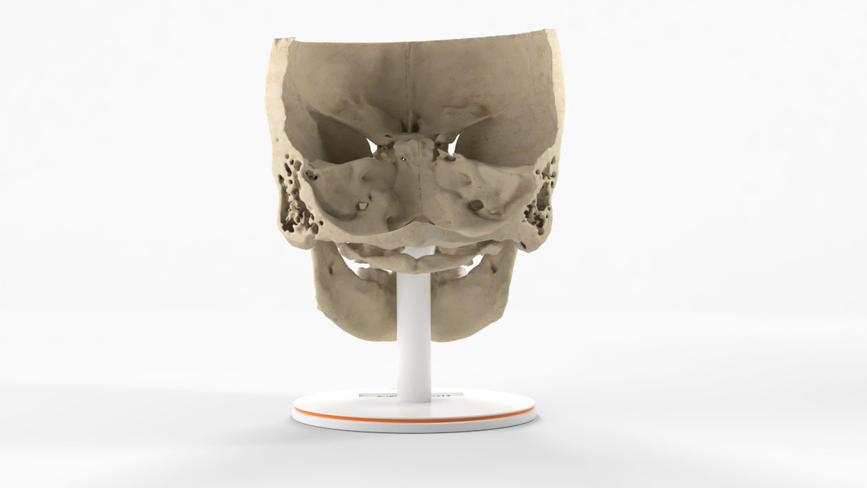 Maxillary Sinus Tumor