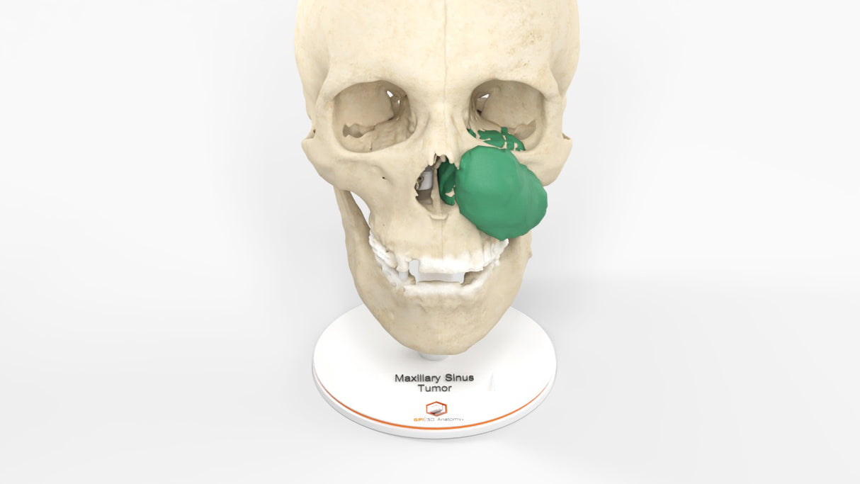 Maxillary Sinus Tumor