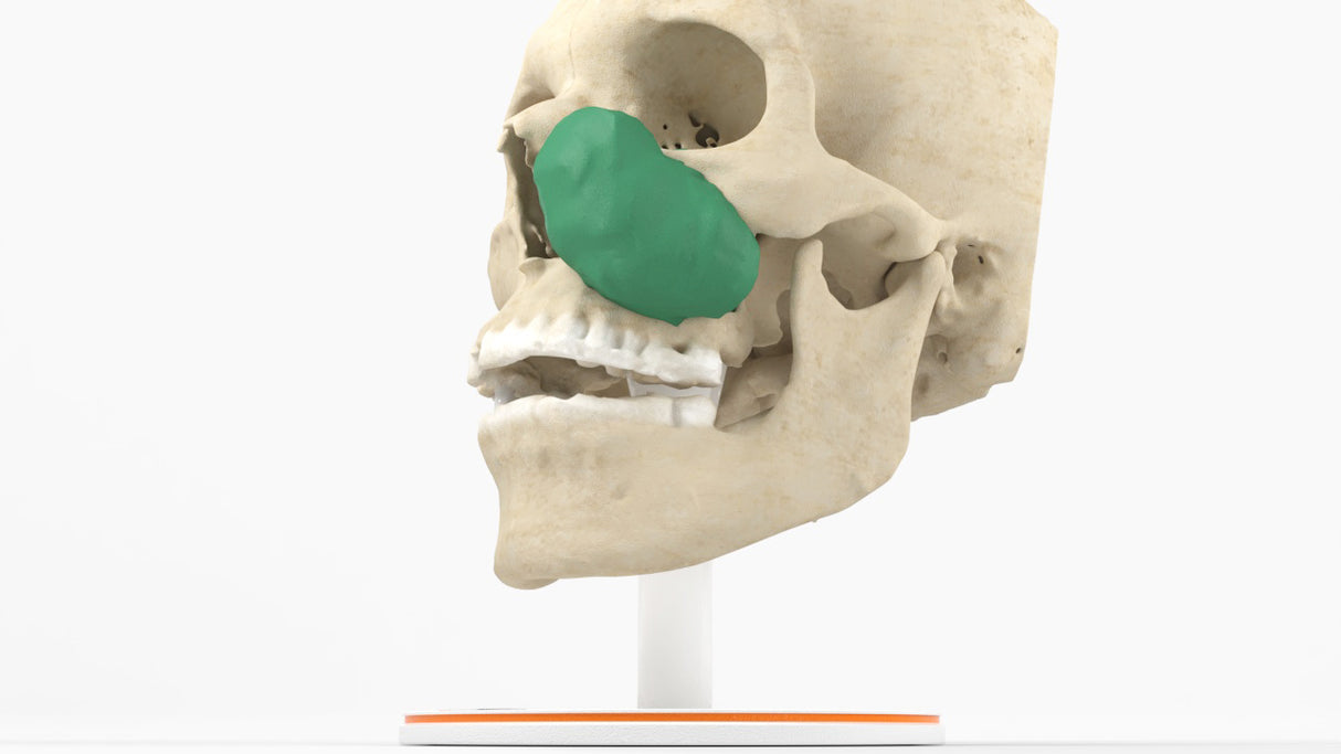 Maxillary Sinus Tumor