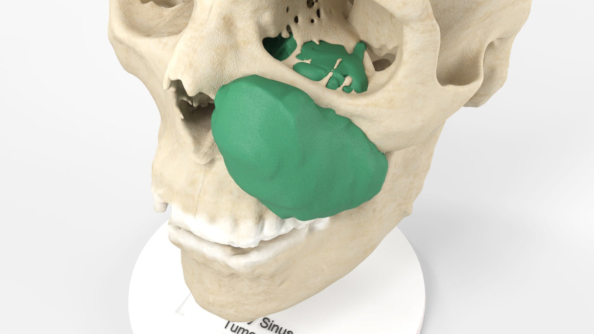 Maxillary Sinus Tumor