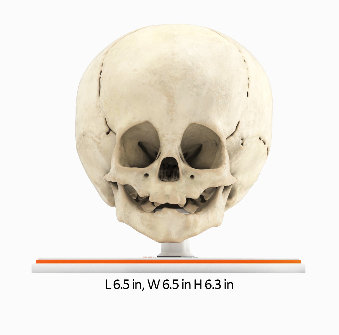 Infant Skull With Craniosynostosis of the Metopic Suture - Male, 8 Months