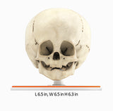 Infant Skull With Craniosynostosis of the Metopic Suture - Male, 8 Months