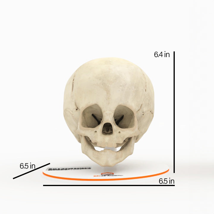 Infant Skull With Craniosynostosis of the Metopic Suture - Male, 8 Months