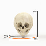 Infant Skull With Craniosynostosis of the Metopic Suture - Male, 8 Months