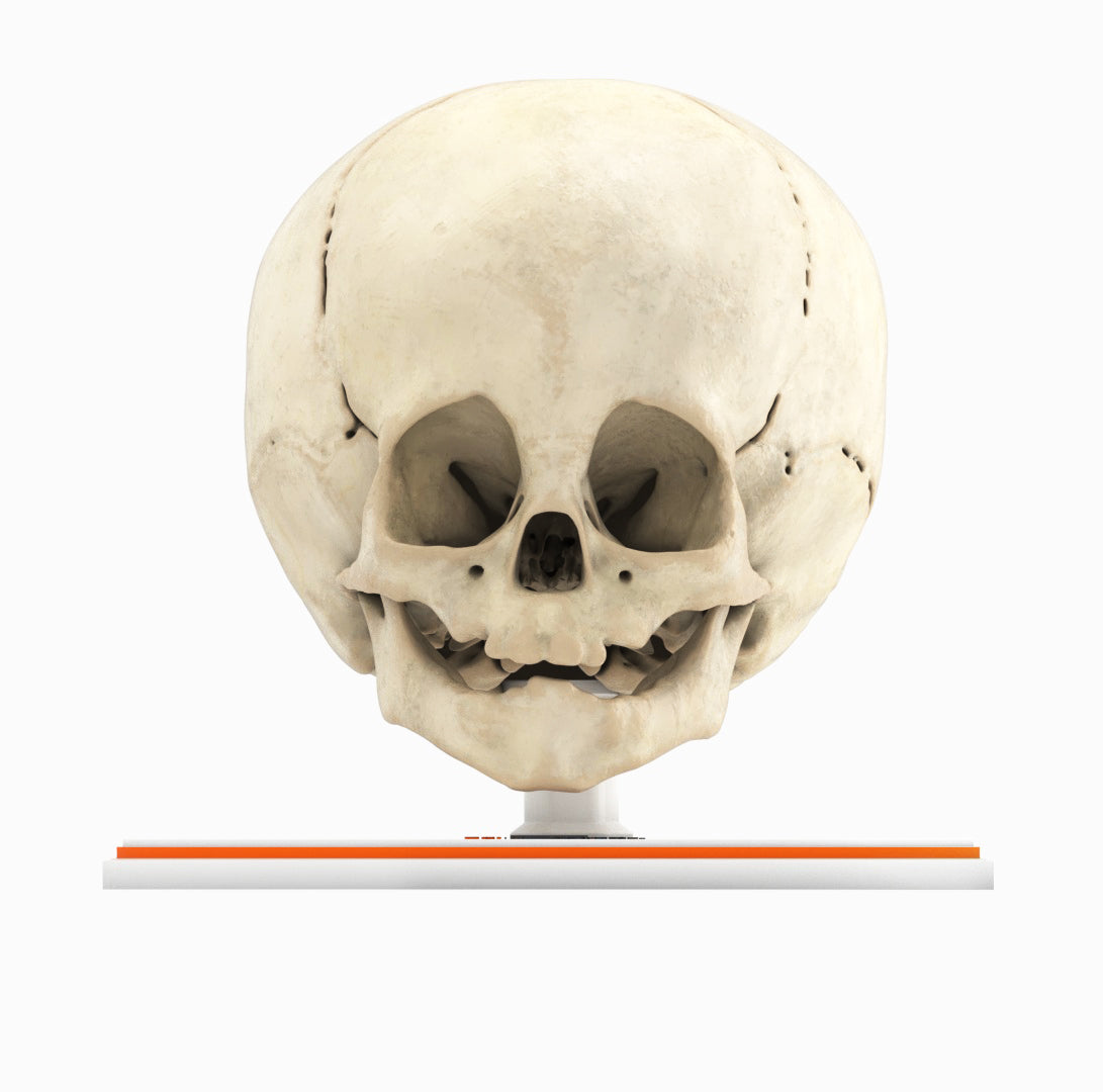 Infant Skull With Craniosynostosis of the Metopic Suture - Male, 8 Months