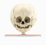 Infant Skull With Craniosynostosis of the Metopic Suture - Male, 8 Months