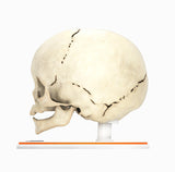 Infant Skull With Craniosynostosis of the Metopic Suture - Male, 8 Months