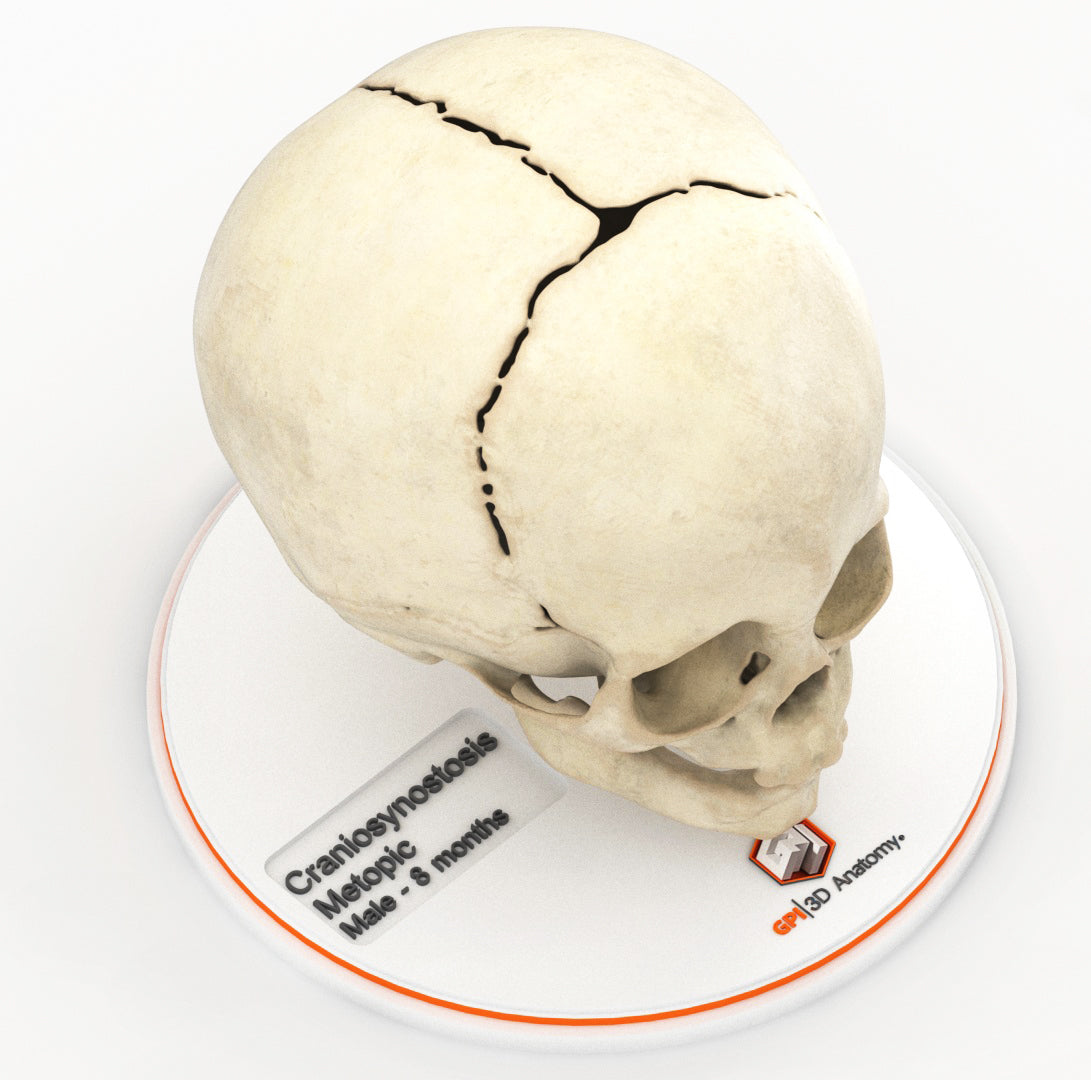 Infant Skull With Craniosynostosis of the Metopic Suture - Male, 8 Months