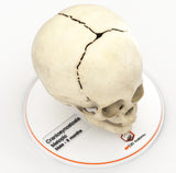 Infant Skull With Craniosynostosis of the Metopic Suture - Male, 8 Months