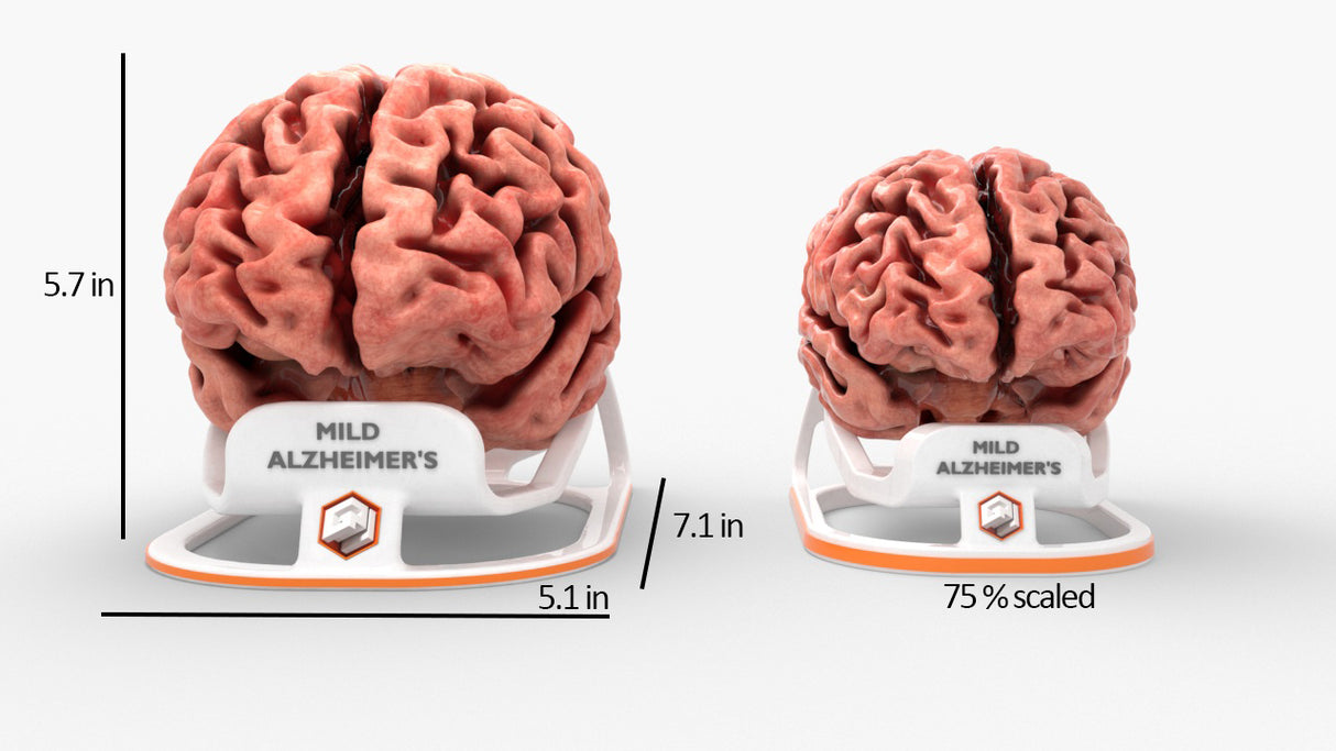 Adult Brain With Alzheimer’s Disease, Mild