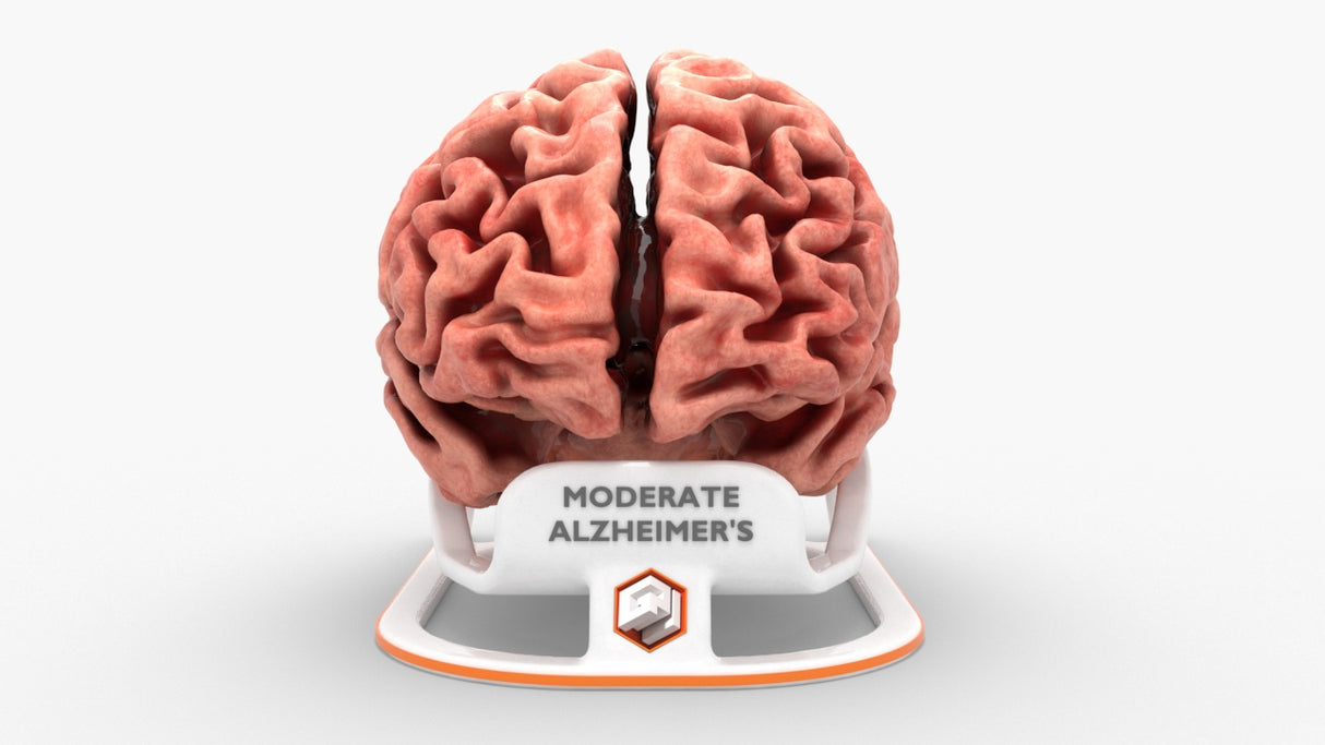 Adult Brain With Alzheimer’s Disease, Moderate