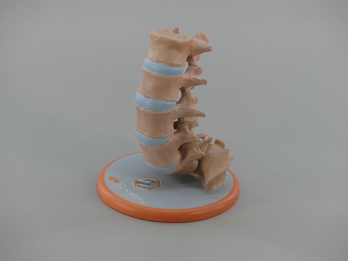 Spine With Spondylolisthesis (Anterolisthesis), Grade 5