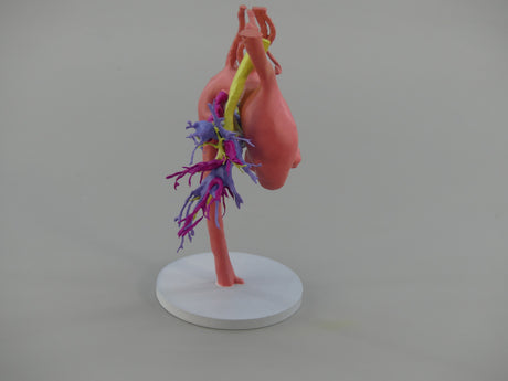 Pulmonary Atresia (Patent Ductus Arteriosus) - Female, 9 Years