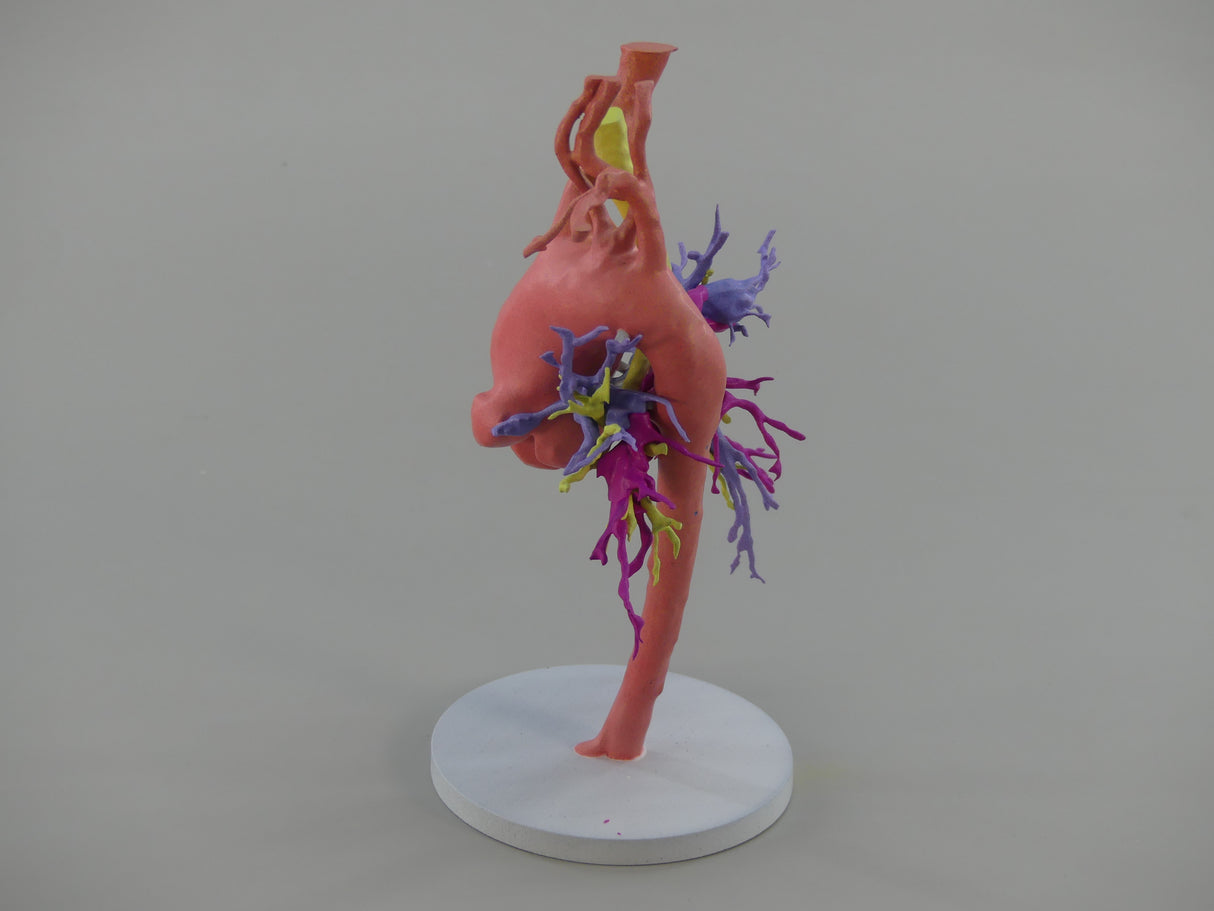 Pulmonary Atresia (Patent Ductus Arteriosus) - Female, 9 Years