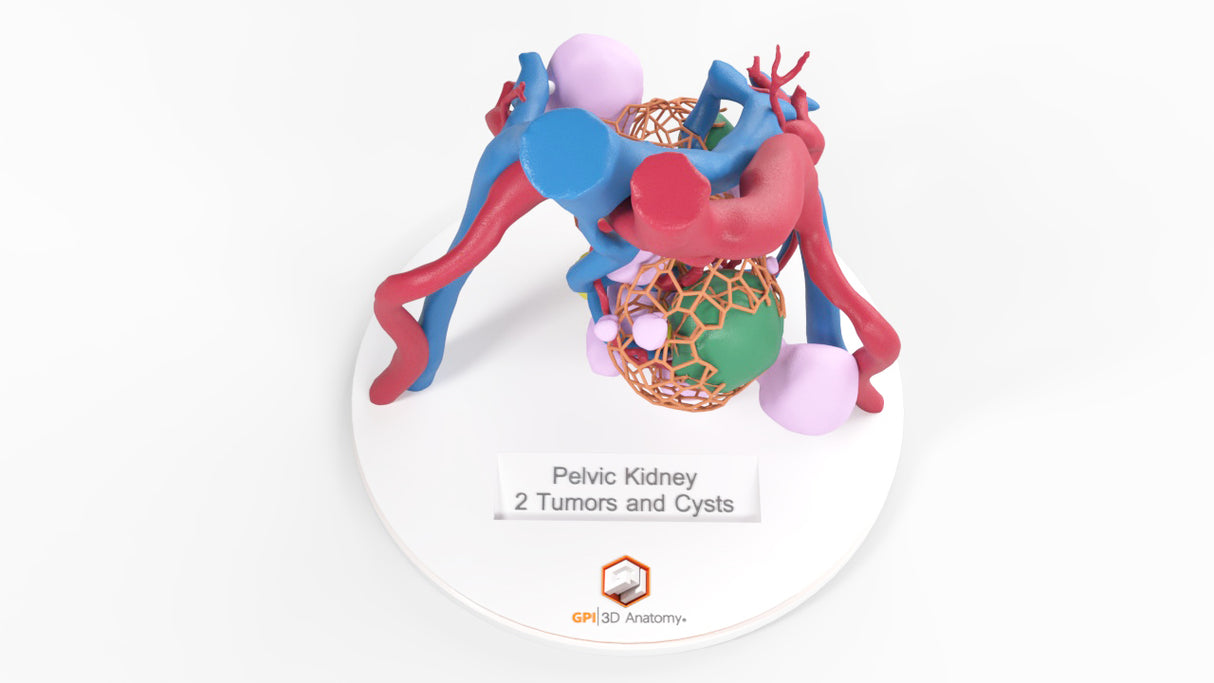 Lattice Pelvic Kidney With Neoplasm and Cysts - Male, 78 Years